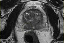 MRI of the prostate